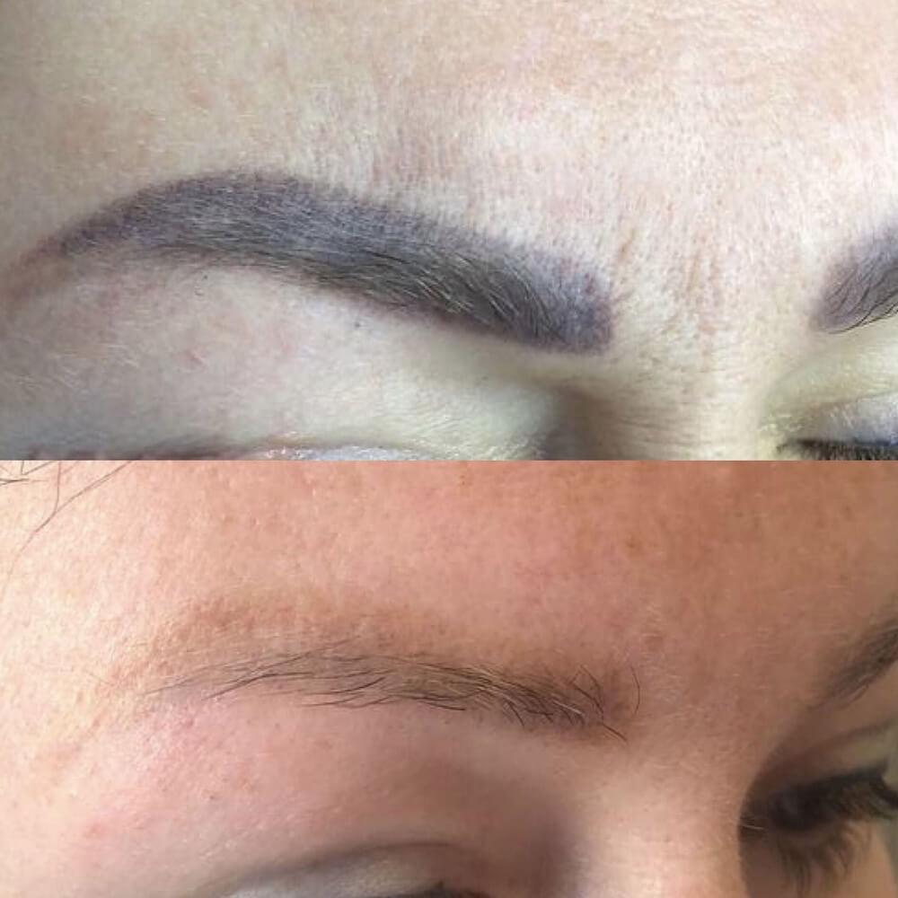 Laserowe usuwanie makijażu permanentnego