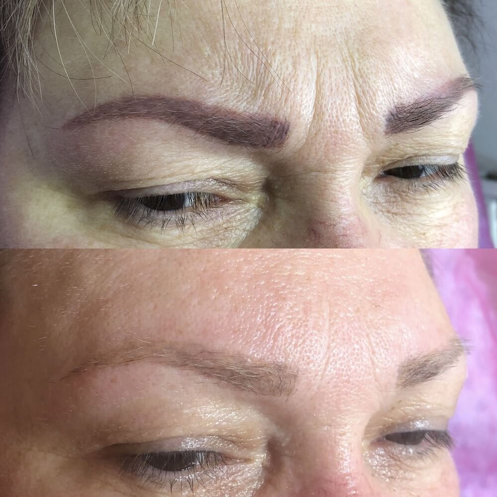 Laserowe usuwanie makijażu permanentnego