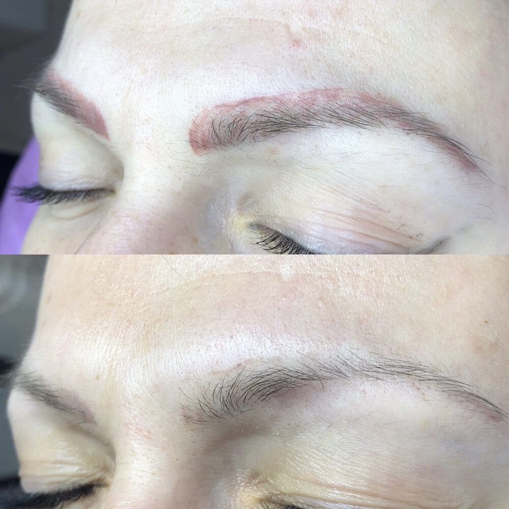 Laserowe usuwanie makijażu permanentnego