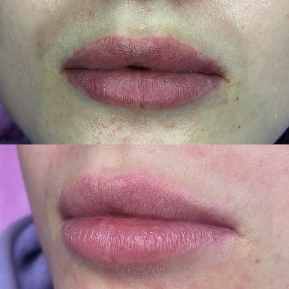 Laserowe usuwanie makijażu permanentnego