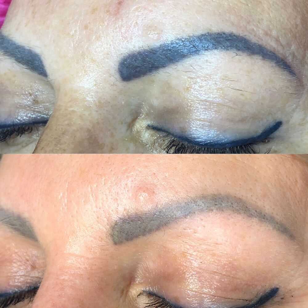 Laserowe usuwanie makijażu permanentnego