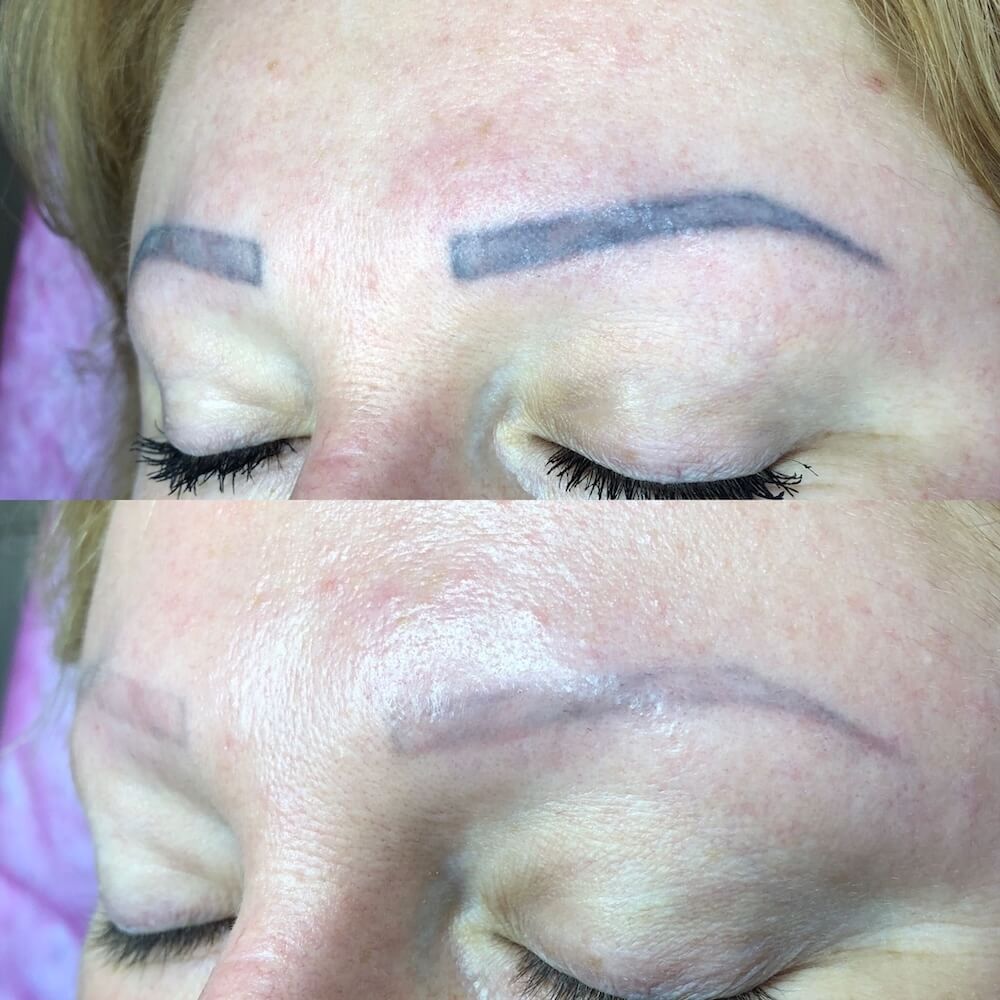 Laserowe usuwanie makijażu permanentnego